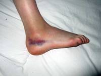 tratament articular după luxație tratați articulația pe picioare